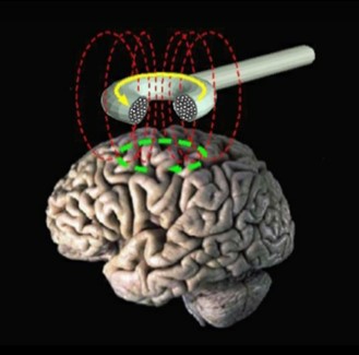 Transcranial Magnetic Stimulation
